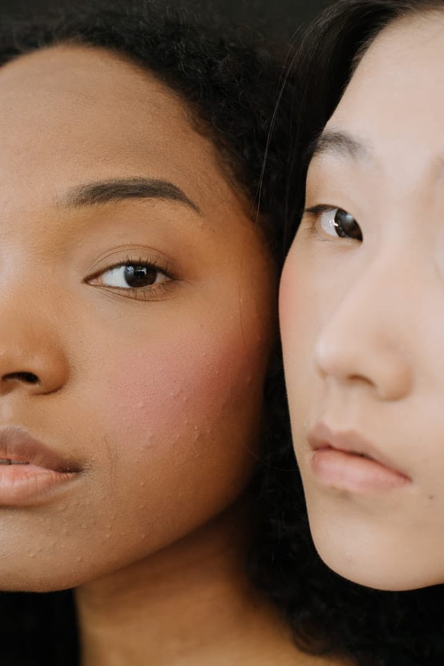 Quais são os tipos de acne?
