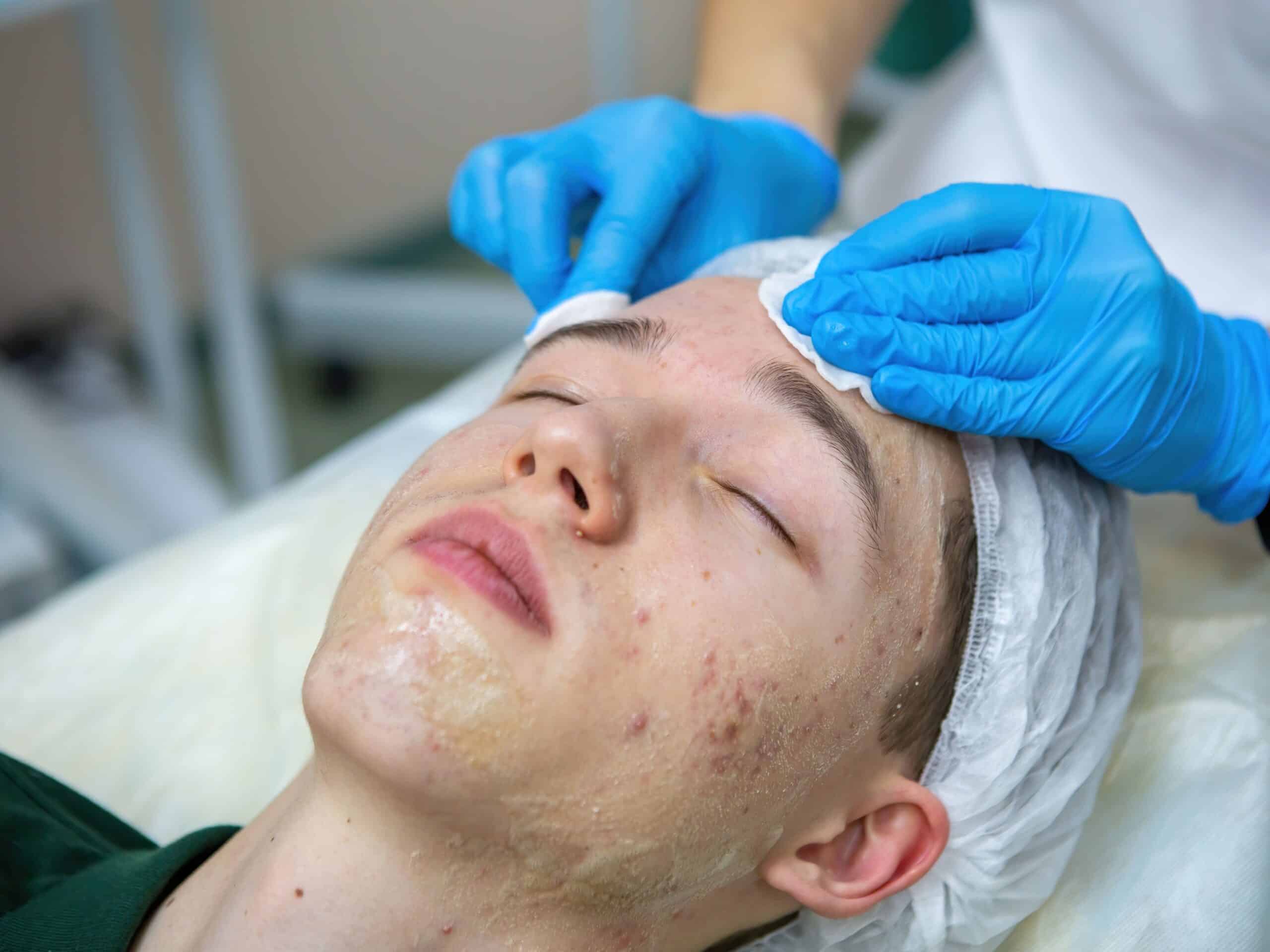 Importância do dermatologista para o combate de acnes e espinhas